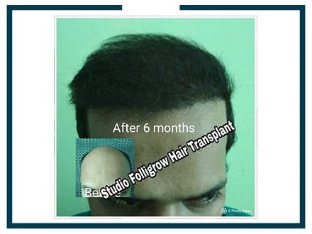 Hair-Transplant-Result