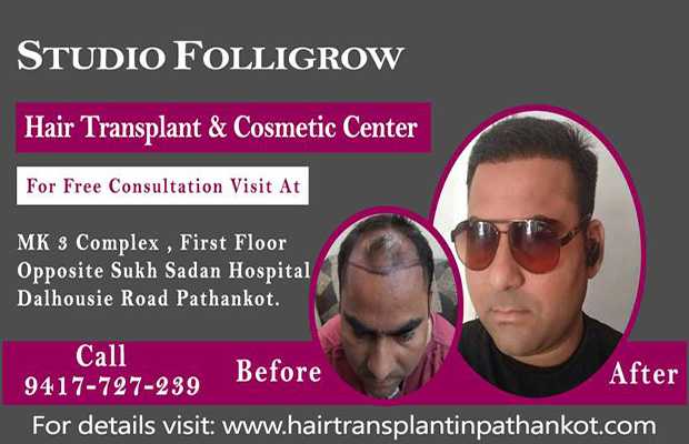 Hair Transplant in Jalandhar – Studio Folligrow