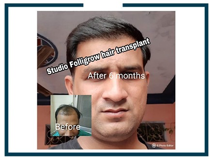 Studio Folligrow – Best Hair Transplant Clinic in Punjab
